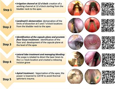 Proctored Step by Step Training Program for GreenLight Laser Anatomic Photovaporization of the Prostate: A Single Surgeon's Experience